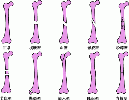 骨折线的常见类型