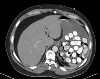 胃内异物（CT扫描）