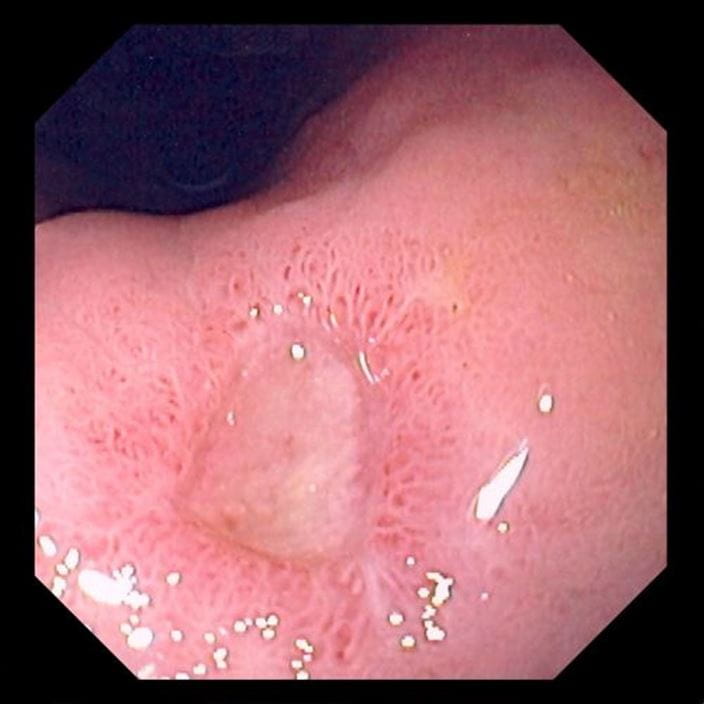 gastric_ulcer_high_zh