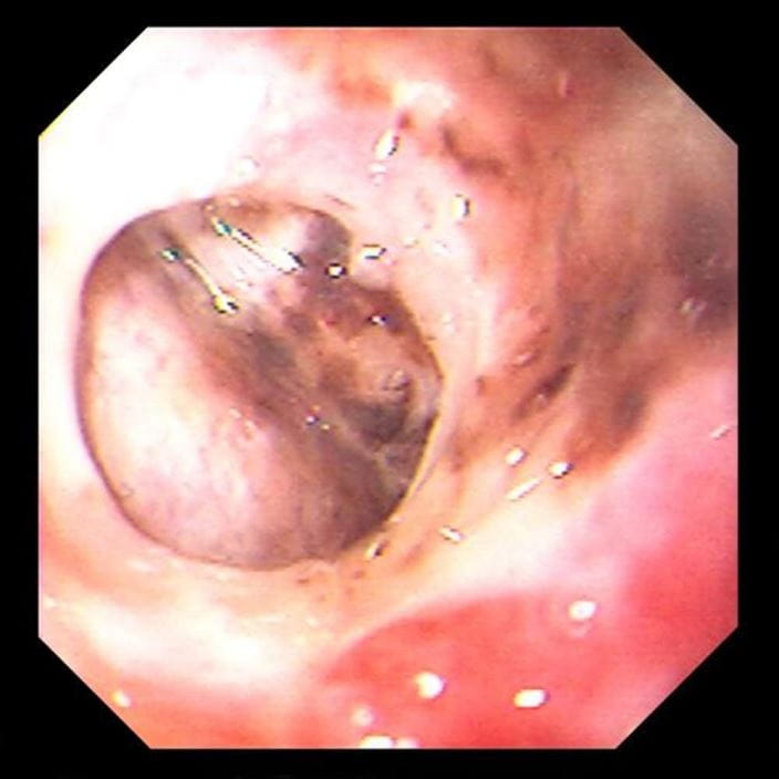 gastric_ulcer_perforation_high_zh