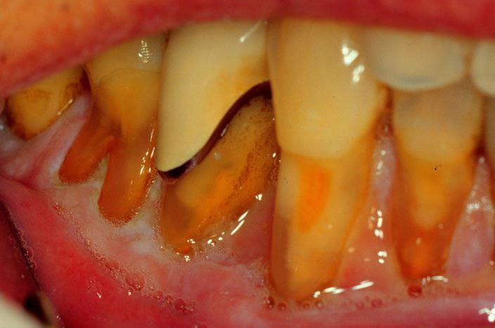 gingival_recession_orig_zh
