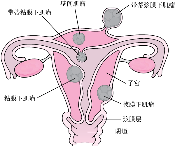 子宫肌瘤的解剖位置
