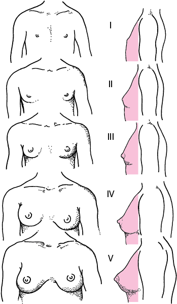 女孩乳房发育的Tanner Ⅰ－V期图解
