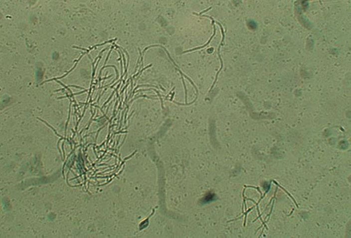 hyphae_and_spores_in_candidal_vaginitis_high_zh