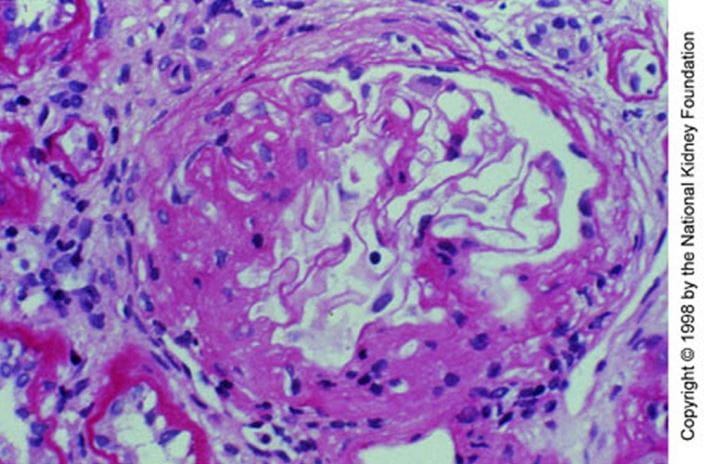 iga_nephropathy_mesangial_expansion_high_zh