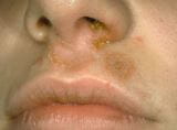 皮肤葡萄球菌感染