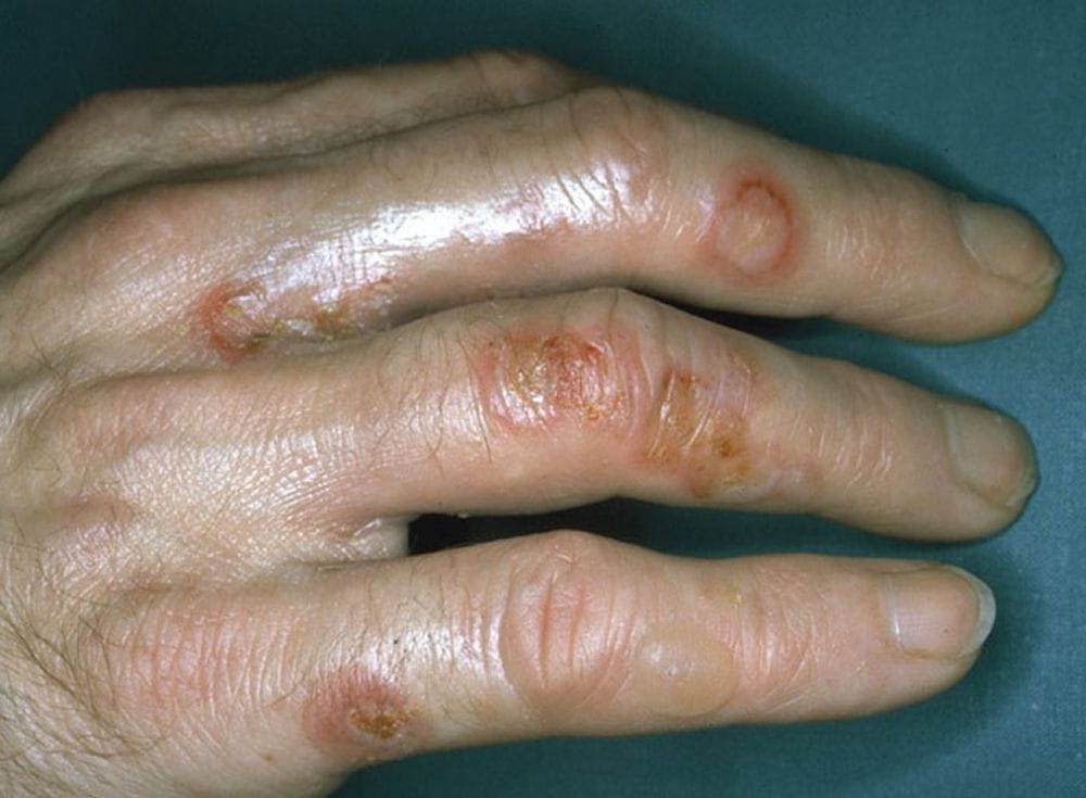 手指长疔疮症状图片图片