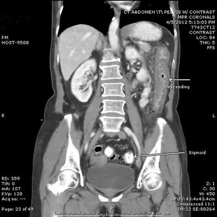 ischemic_colitis_on_CT_high_zh