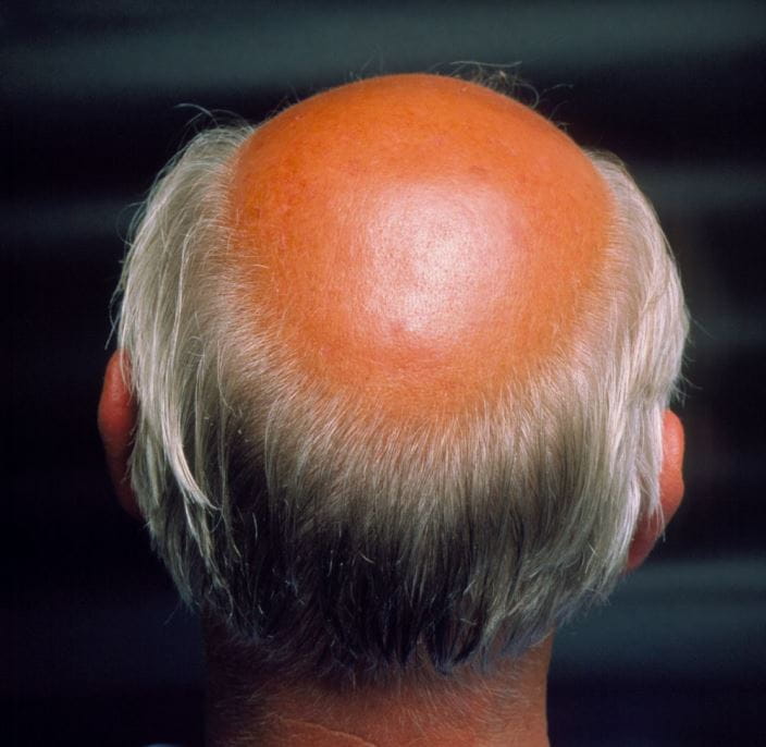 m1080349-androgenetic-alopecia-science-photo-library-high_zh