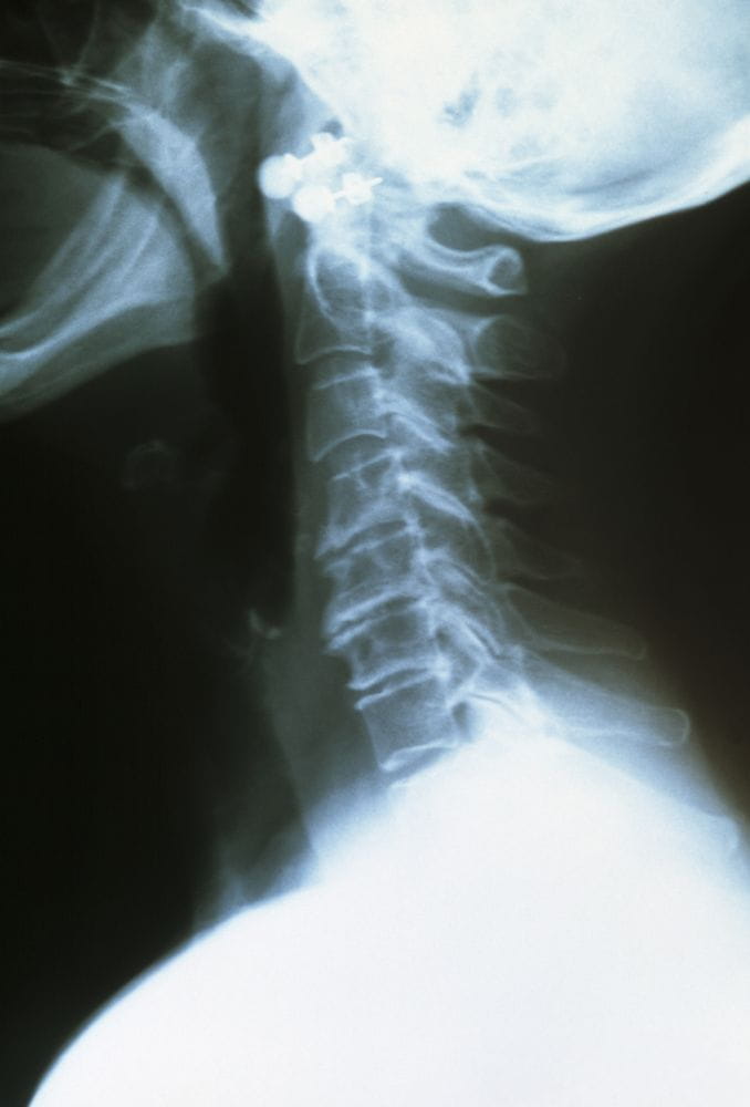 m1100459_osteoarthritis_of_the_neck_science_photo_library_high_zh