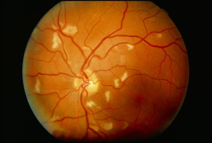 m1120236-retinitis-cytomegalovirus-science-photo-library-high_zh
