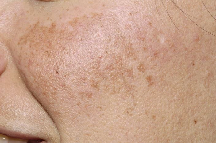m1301021-melasma-science-photo-library-high_zh