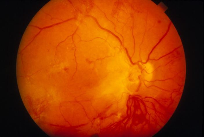m1400070-diabetic-retinopathy-proliferative-science-photo-library-high_zh