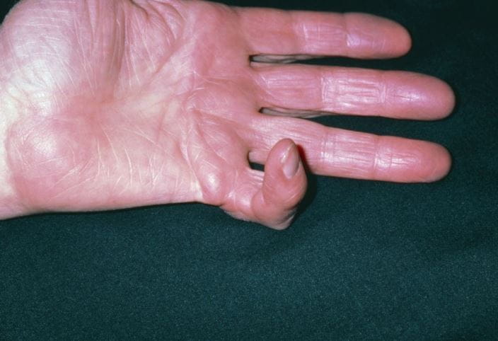 m1400187_dupuytrens_contracture_of_little_finger_science_photo_library_high_zh