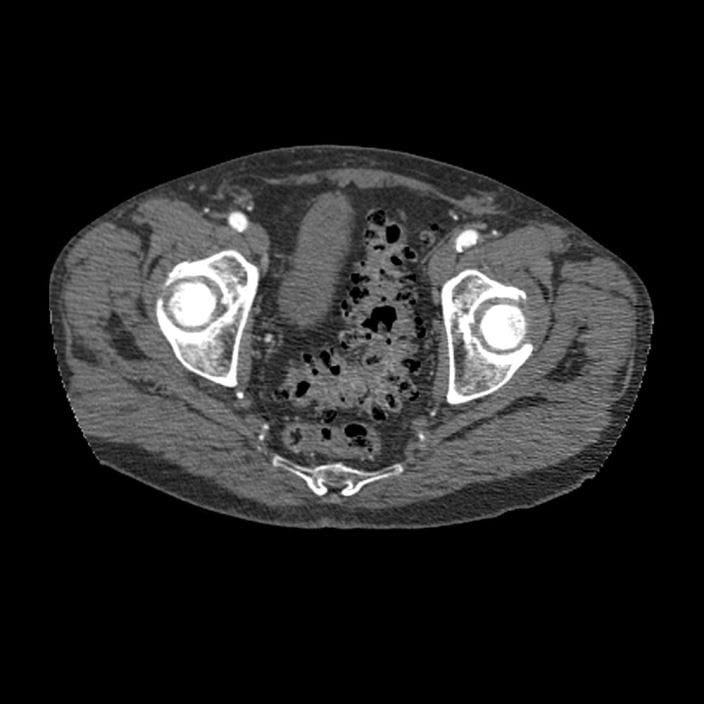 m1400430-diverticulosis-ct-scan-science-photo-library-high_zh