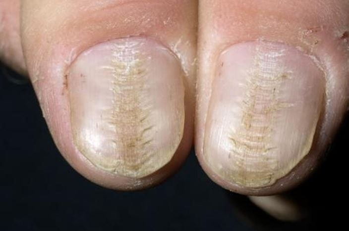 m1400437-median-nail-dystrophy-science-photo-library-high_zh