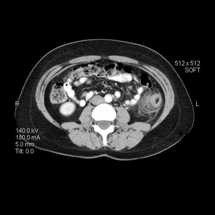 m1400445-diverticulitis-ct-scan-science-photo-library-high_zh