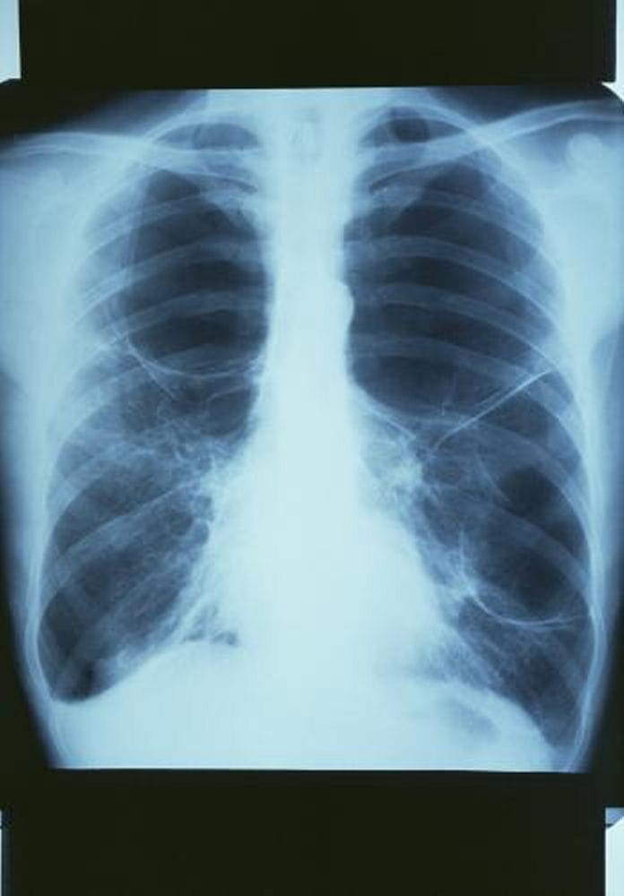 m1500338_copd_with_bullae_x-ray_science_photo_library_high_zh
