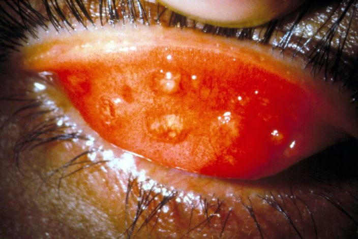 m1550069-stage-2-trachoma-science-photo-library-high_zh