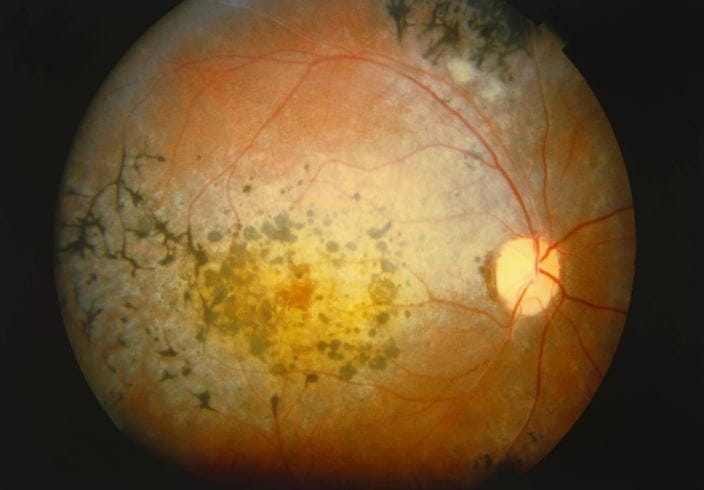 m1550212-retinitis-pigmentosa-science-photo-library-high_zh