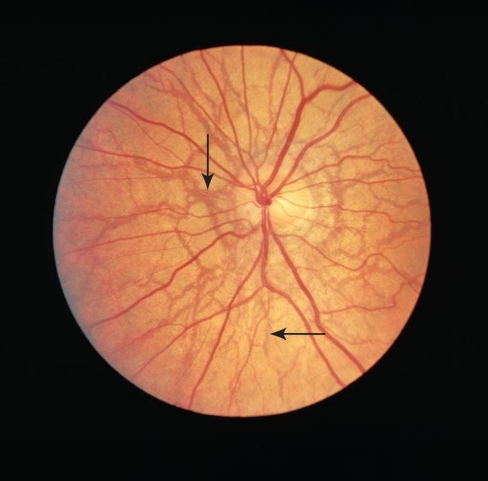 m1550319_ophthalmoscope_view_of_retina_with_angioid_streaks_science_photo_library_arrows_high_zh