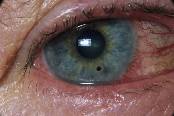 m1550510-foreign-body-in-eye-science-photo-library-high_zh