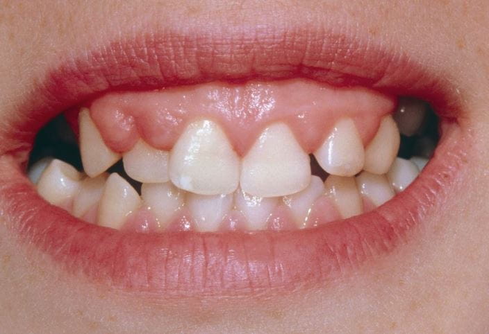 m1700095-gingival-hyperplasia-science-photo-library-high_zh