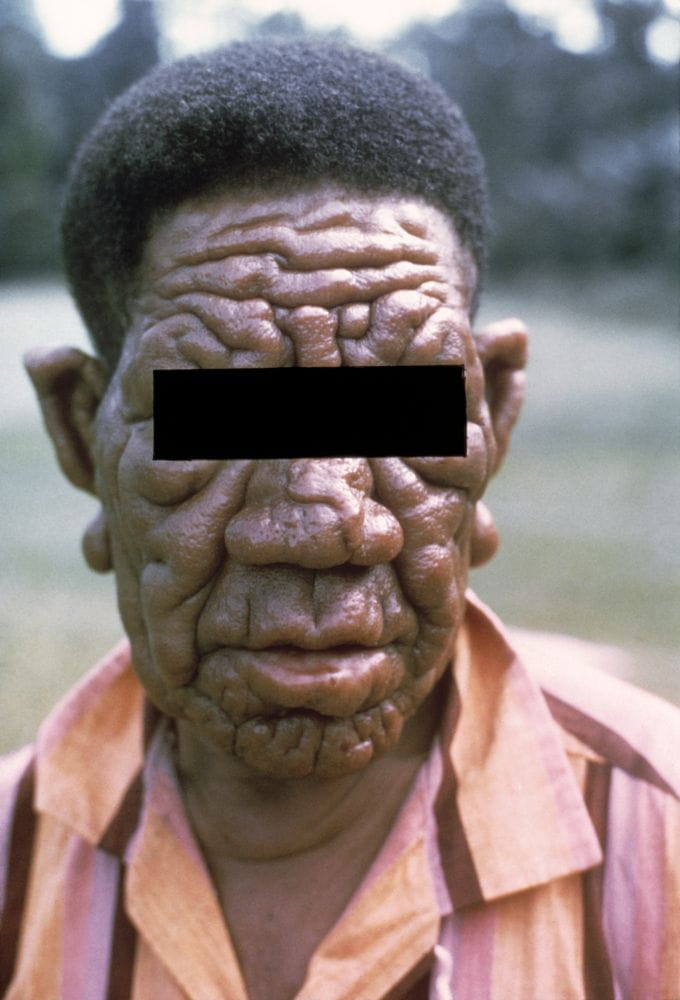m2000015_lepromatous_leprosy_science_photo_library_high_zh