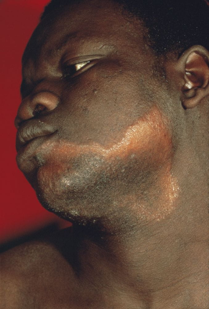 m2000171_tuberculoid_leprosy_science_photo_library_high_zh