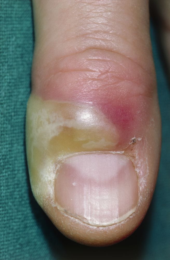 手指甲沟炎症状图片