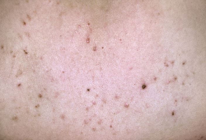 m2400234-pityriasis-lichenoides-science-photo-library-high_zh