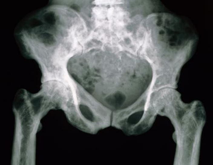 m2400309-x-ray-of-the-pelvis-in-paget-disease-science-photo-library-high_zh