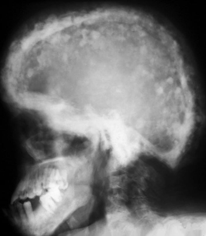 m2400488-xray-of-the-skull-in-paget-disease-science-photo-library-high_zh