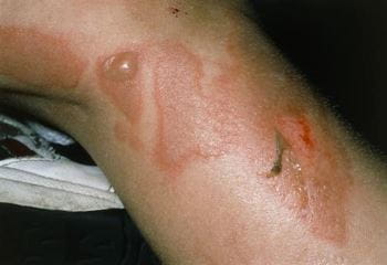 葡萄球菌性烫伤样皮肤综合征（腿部）