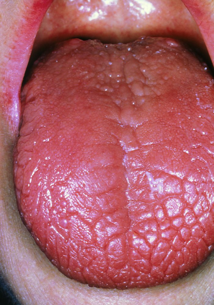 m2600013_dry_tongue_in_sjogren_s_syndrome_science_photo_library_high_zh