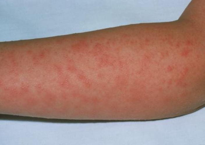 m2600054-scarlet-fever-rash-on-a-patients-arm-science-photo-library-high_zh