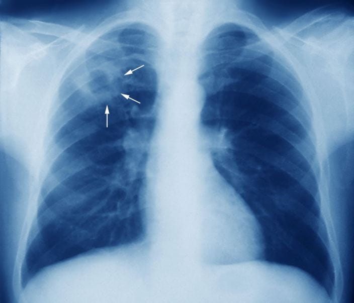 m2700245-tuberculosis-chest-x-ray-science-photo-library-high_zh