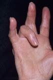 手指屈肌腱炎和腱鞘炎（扳机指）