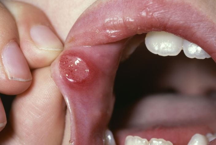m2800216-minor-aphthous-ulcer-lip-science-photo-library-high_zh