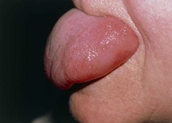 舌血管性水肿