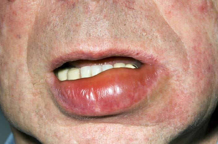 m3200446-angioedema-of-the-lips-science-photo-library-high_zh