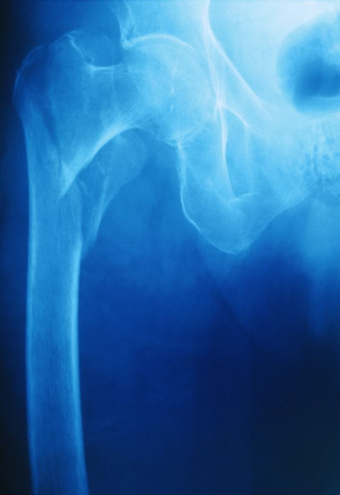 m3300132_intertrochanteric_hip_fracture_science_photo_library_high_zh