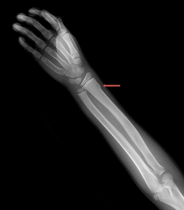 m3301473_torus_wrist_fracture_arrow_science_photo_library_high_zh