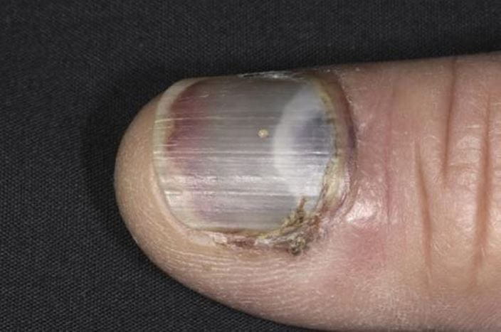 m3301703_bruised_fingernail_science_photo_library_high_zh