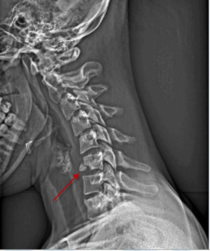 M3301728-cervical-vertebral-body-fracture-x-ray-science-photo-library-arrow-high_zh