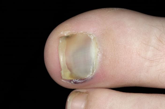 m3301747_bruised_toenail_science_photo_library_high_zh