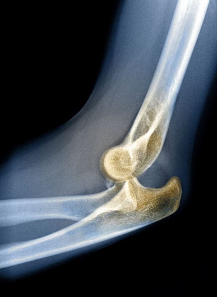 m3301781_posterior_elbow_dislocation_science_photo_library_high_zh