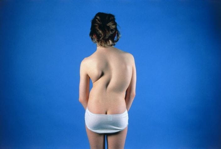 m3500184-idiopathic-scoliosis-consumer-science-photo-library-high_zh