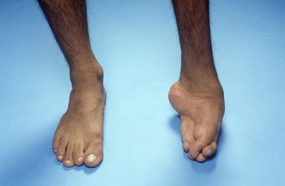 足趾畸形有哪几种图片图片