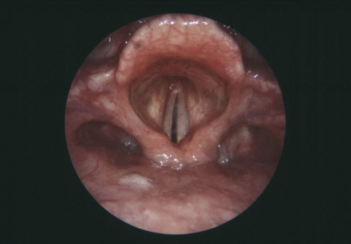 m3600187-vocal-cord-paralysis-science-photo-library-high_zh